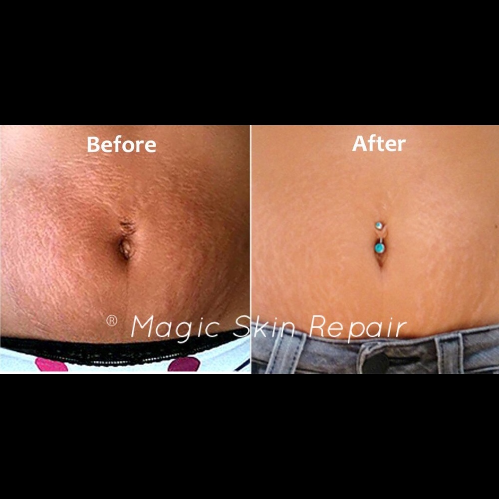 Get rid of stretch marks , scars, wrinkles, etc